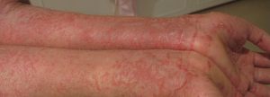 The Epidemic of Atopic Dermatitis